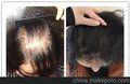 近一直掉头发脱发防脱脉塔瑶元堂