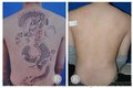 惠州洗纹身之激光洗纹身护理不当容易留疤