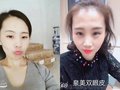 泉美无针双眼皮-无针加盟